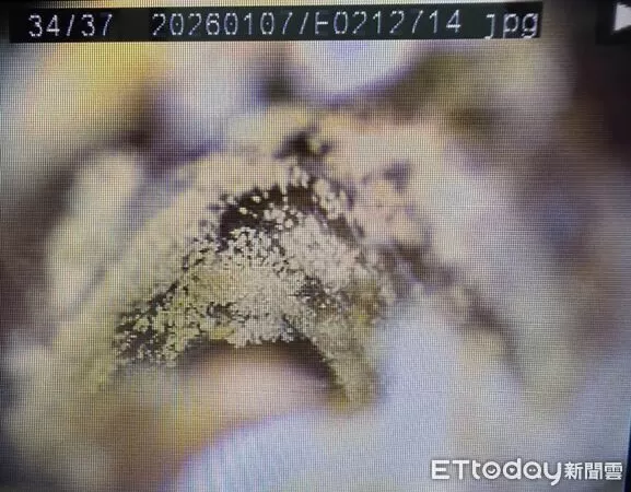 ▲年輕妹好癢！兩耳炸出「毛茸茸一整片」醫看呆　壞習慣害發霉了。(圖/黃士倫醫師授權提供)