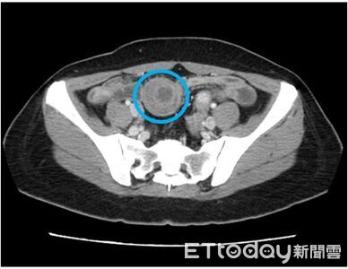 胃痛別輕忽！她腸子像「望遠鏡」縮進去　罕見腫瘤引發腹內災難
