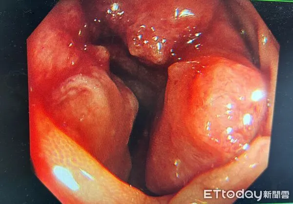 ▲腸內竟有一顆3公分大惡性腫瘤，猶如一顆乒乓球大小，趕緊安排腫瘤切除。（圖／豐原醫院提供）