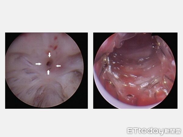 ▲仁愛長庚合作聯盟醫院泌尿科團隊以內視鏡技術放置鎳鈦金屬尿道支架，協助頑固型膀胱頸狹窄患者改善排尿問題。（圖／記者游瓊華翻攝）