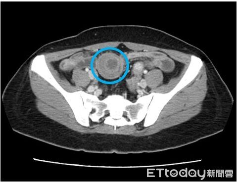 胃痛別輕忽!她腸子像「望遠鏡」縮進去 罕見腫瘤引發腹內災難