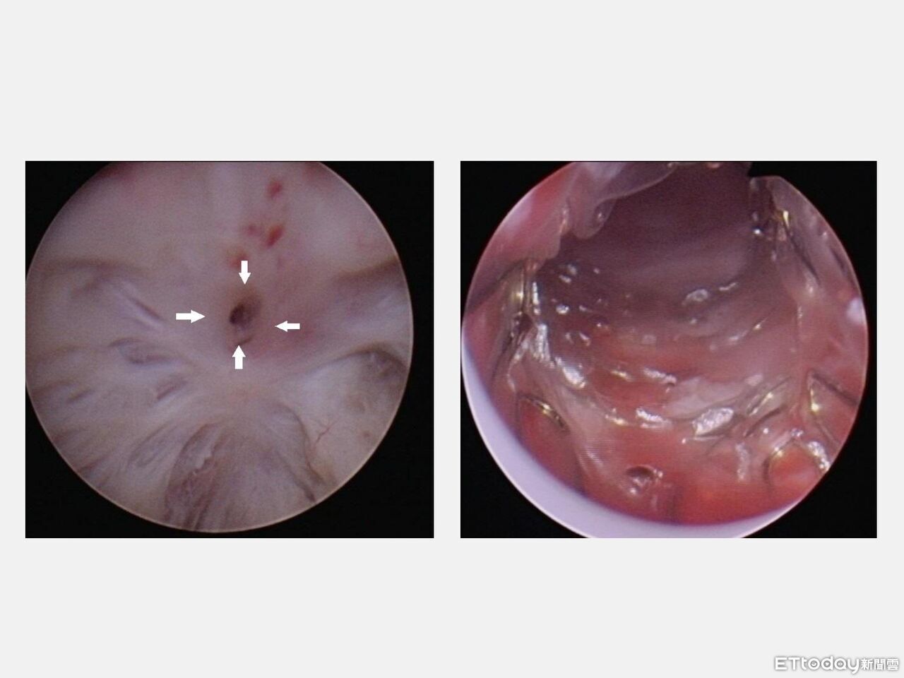 攝護腺手術後「反覆排尿困難」 鎳鈦尿道支架助65歲男重拾暢通