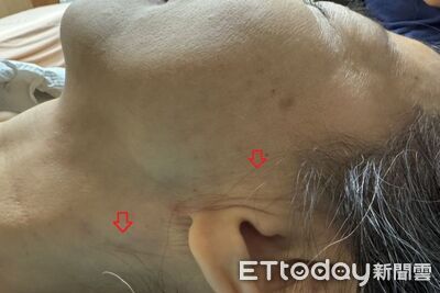 婦人左臉頰突長4公分腫塊 竟是罕見「腮腺癌」