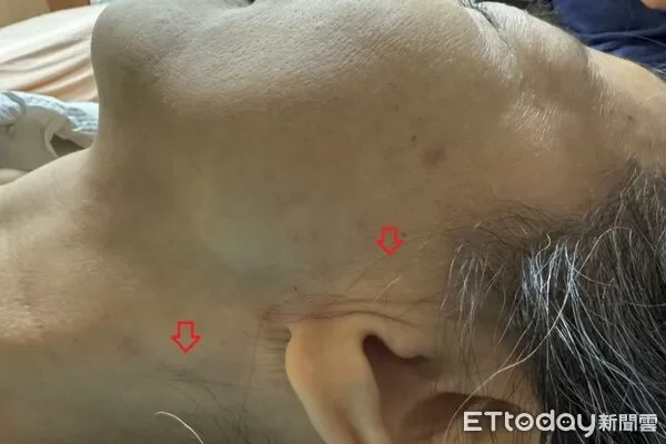 腮腺腫瘤。（圖／台北慈濟醫院提供）