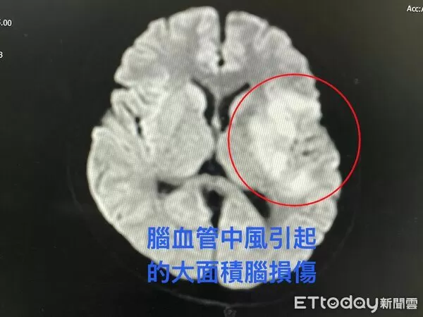 ▲從核磁共振影像檢查中明顯看見，因為腦血管中風造成王先生左側腦組織大面積損傷。（圖／慈濟醫學中心提供，下同）