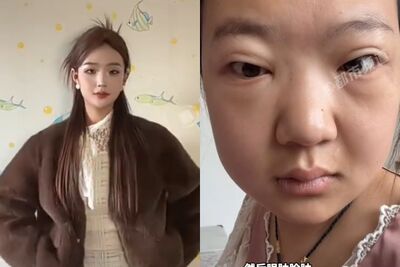 24歲正妹激增29kg以為變胖竟是「尿毒症」惹禍　她嘆：愛吃大辣