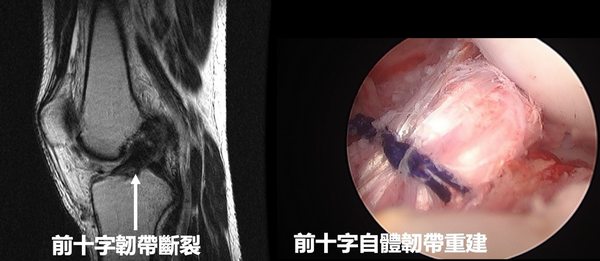 ▲滑雪一摔前十字韌帶斷裂