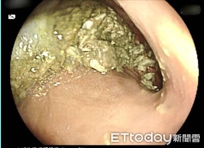 空腹10小時胃仍積食「險塞住幽門」　瘦瘦針用藥風險曝光