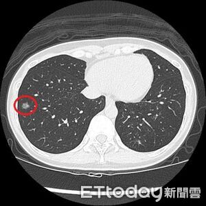 40歲女戒菸2年沒不適　篩出右肺長小顆「毛玻璃結節」確診肺癌