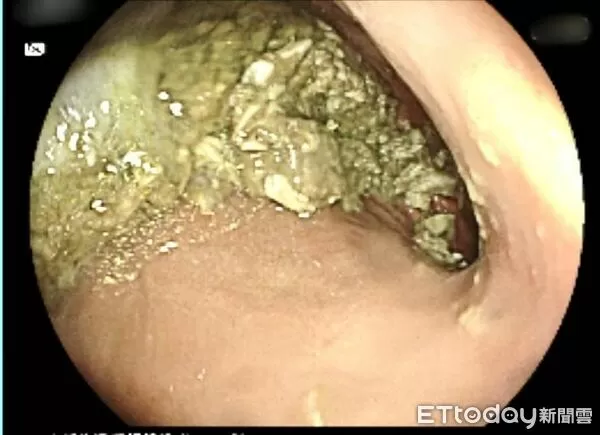 ▲▼  ［打瘦瘦針未告知 空腹檢查胃仍大量積食］    。（圖／聖馬爾定醫院提供）