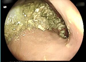 空腹10小時胃仍積食「險塞住幽門」　瘦瘦針用藥風險曝光