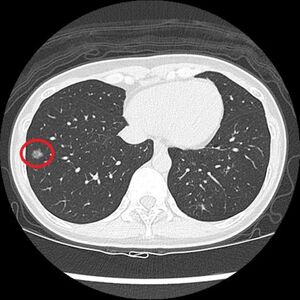 40歲女戒菸2年沒不適　篩出右肺長小顆「毛玻璃結節」確診肺癌