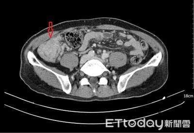 腹瀉腹脹別輕忽！他罹多發性結腸癌擴散腹腔　治療成果登國際期刊