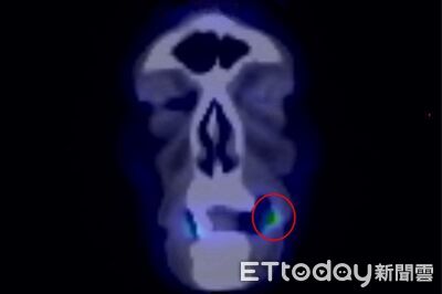 嘴破別再忍!男「反覆潰瘍」不痛不癢 醫一查:已癌症二期