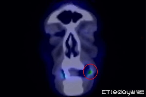 嘴破別再忍！男「反覆潰瘍」不痛不癢　醫一查：已癌症二期
