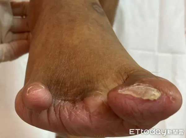 ▲▼      耳念珠菌       。（圖／醫師提供）