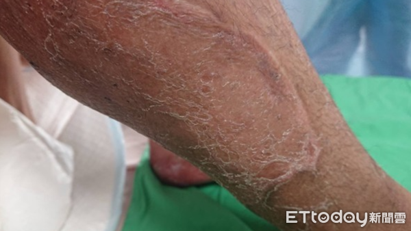 ▲▼      耳念珠菌       。（圖／醫師提供）