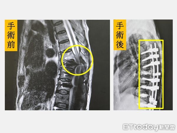 ▲陳老太太因搬動盆栽突感劇痛跌坐在地，經檢查發現胸椎爆裂性骨折壓迫脊髓。（圖／記者游瓊華翻攝）