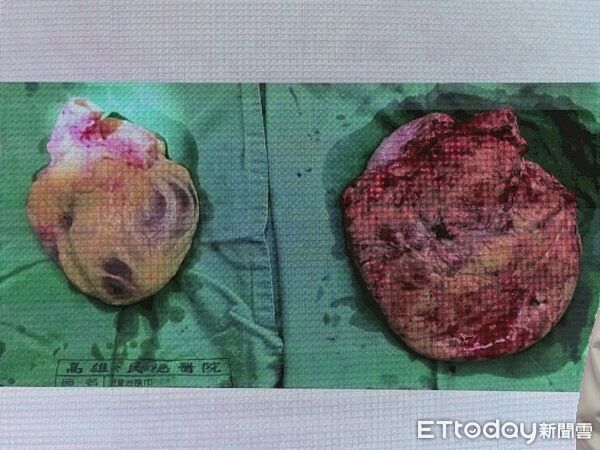 ▲患者的心臟（右）取出時，爛如一塊肉餅。（圖／記者許宥孺攝）