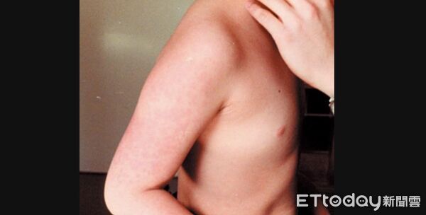 ▲B19,蘋果病。（圖／日本厚生勞動省）