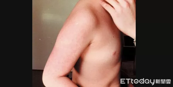 ▲B19,蘋果病。（圖／日本厚生勞動省）