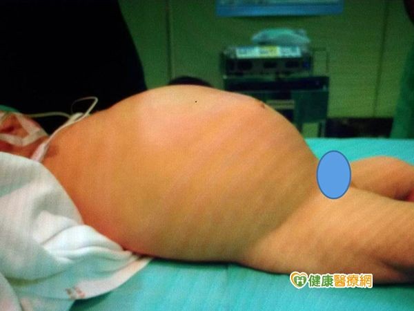 肚子脹大如皮球少見扭轉腸閉鎖 Ettoday健康雲 Ettoday新聞雲