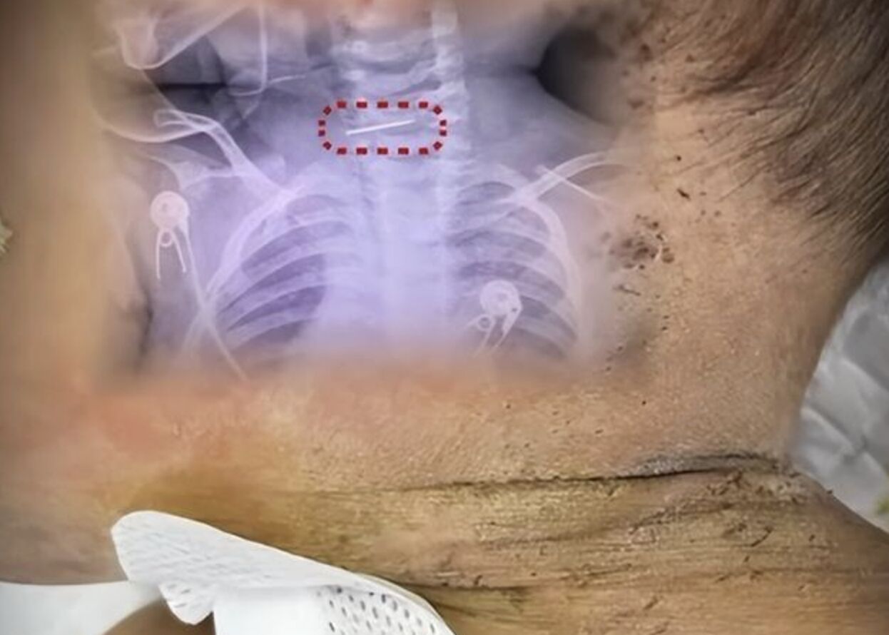 ▲大陸一名男嬰被母親用針扎放血，令人看了十分不捨。（圖／翻攝大風新聞）