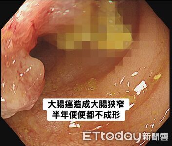 以為長痔瘡！男血便半年「一天拉6次」　醫一照嘆：是大腸癌