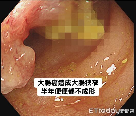 ▲▼以為長痔瘡！男血便半年「一天拉6次」　醫一照嘆：是大腸癌。（圖／林相宏醫師授權提供）