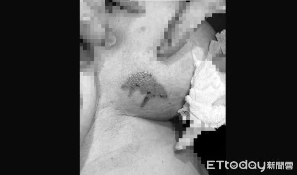 ▲▼創意抗寒變慘劇！台中婦突發奇想把暖暖包塞乳溝9小時，拿開驚見已經燙傷，還流膿。（圖／茂盛醫院提供）