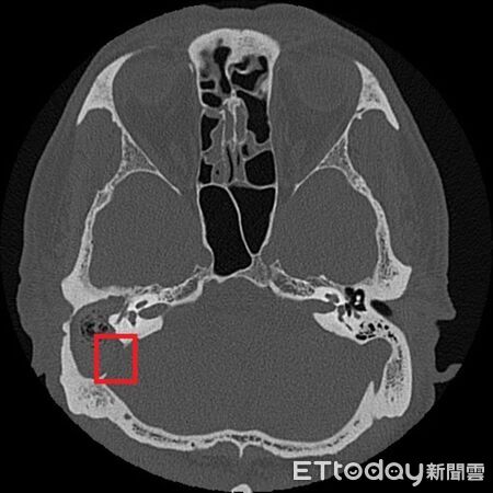▲▼     膽脂瘤        。（圖／台北慈院提供）