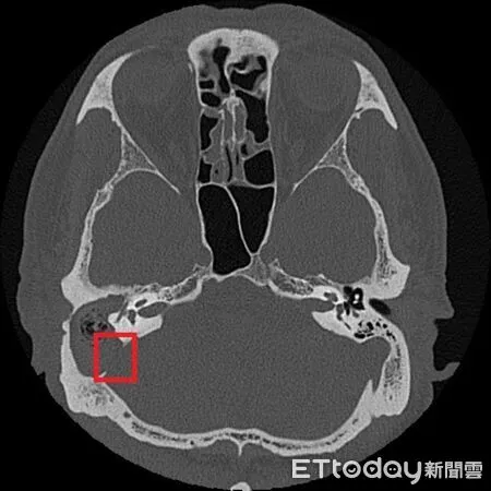 ▲▼     膽脂瘤        。（圖／台北慈院提供）
