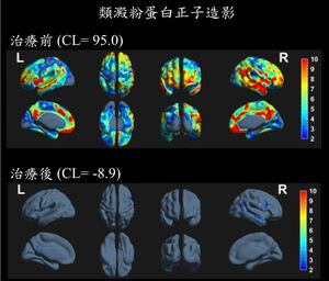 76歲CEO記憶力障礙、腦霧　失智症新藥治半年「異常蛋白清零」