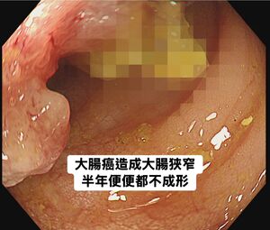 以為長痔瘡！男血便半年「一天拉6次」　醫一照嘆：是大腸癌