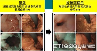 嚴重胃食道逆流「飯後彎個腰就咳」　男接受最新微創治療終於好睡