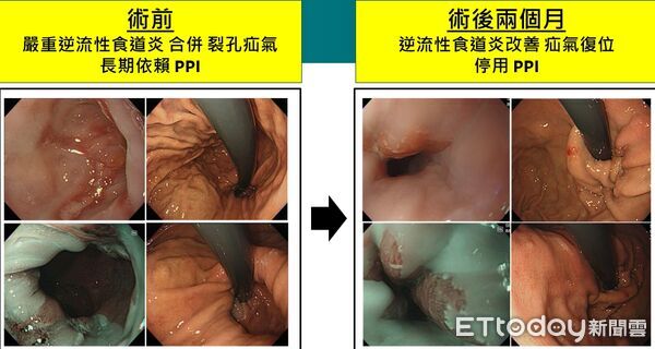 ▲▼   胃食道逆流          。（圖／雙和醫院提供）