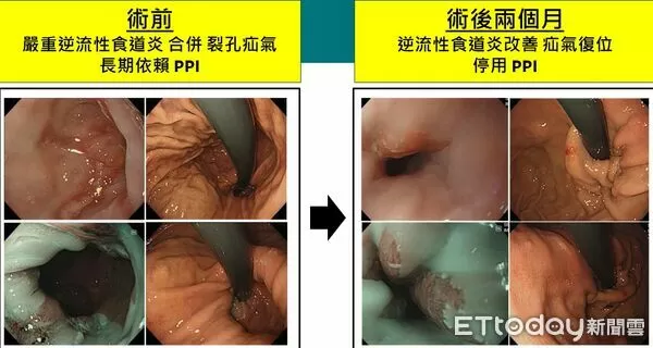 ▲▼   胃食道逆流          。（圖／雙和醫院提供）