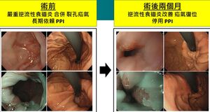 男嚴重胃食道逆流「飯後彎腰就咳」　接受新微創治療3天就出院