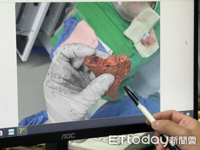 台中甜食女肝臟「6成都是油」還藏2顆腫瘤　切下蘋果大脂肪肝