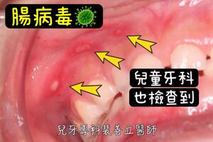 孩子嘴巴「冒好幾個小洞」隔天全班停課！醫：這2處一定要檢查