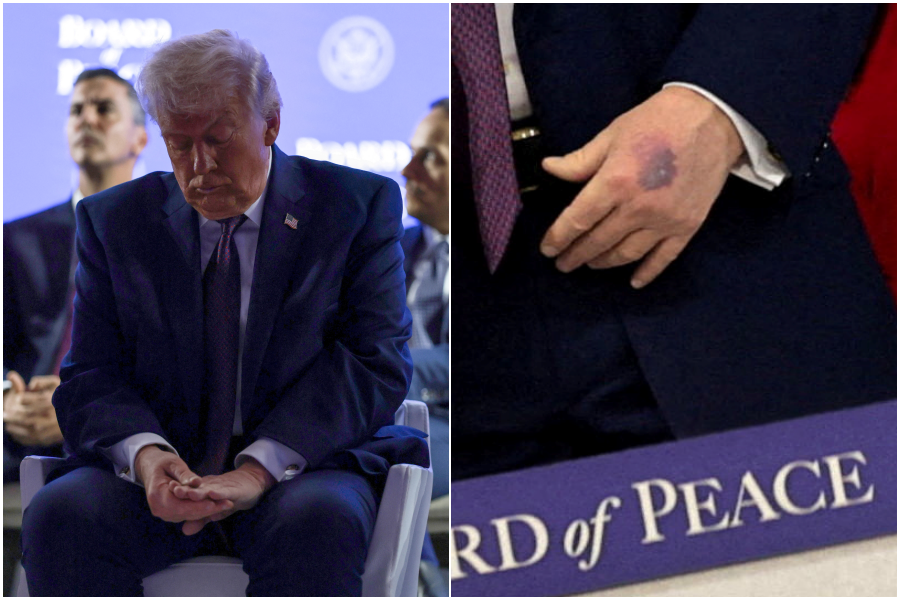 ▲▼ 川普在达沃斯世界经济论坛上观察自己左手上的瘀青。 (图/路透)