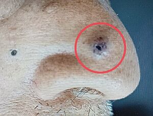 70歲翁鼻頭「有黑痣」竟噴血　醫切片搖頭：是基底細胞癌