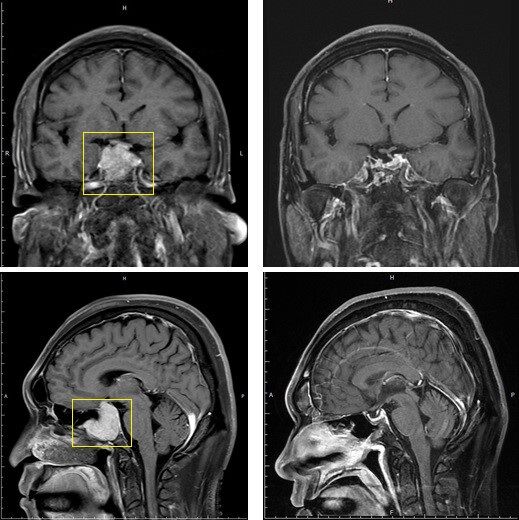 ▲▼病人術前術後對照圖，黃框處為術前腫瘤位置，術後(右側)腫瘤已消失。（圖／北醫附醫提供）