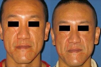 醫美模特打馬仍被認出「是陳為民」！前後對比釣出本人回應