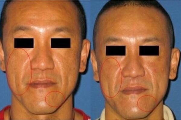 醫美模特打馬仍被認出「是陳為民」！前後對比釣出本人回應