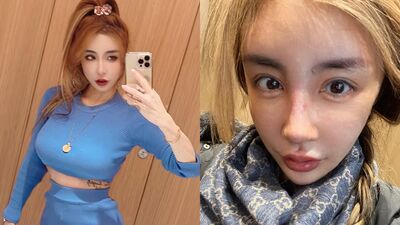 雪碧告別12年假鼻　術後10天曬照：有點上岸的感覺