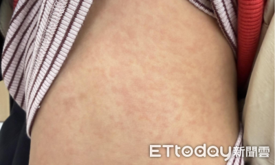 好多小孩爆紅疹！　醫警告「1款衣服」恐是皮膚災難：別直接穿