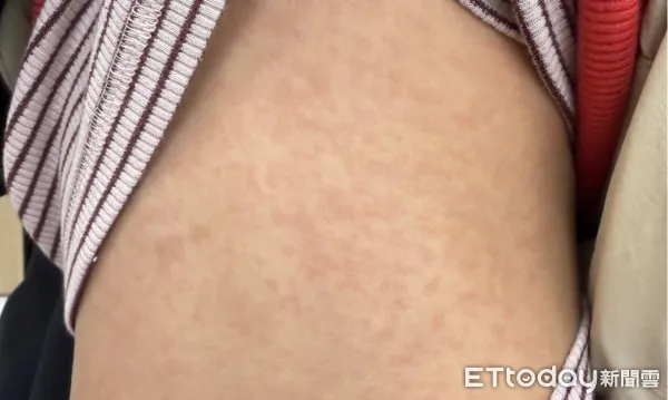 ▲▼好多小孩紅疹大爆發！醫警告「1類衣服」恐是皮膚災難。（圖／顏俊宇醫師授權提供，未經同意請勿任意翻攝）