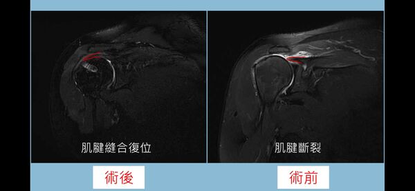 ▲▼中國醫藥大學新竹附設醫院骨科醫師葉詩翰說明五十肩與旋轉肌袖撕裂差異。（圖／中國醫藥大學新竹附設醫院提供）
