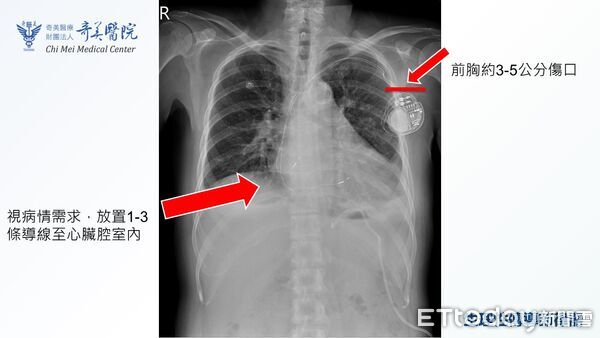 ▲▼    心跳慢         。（圖／奇美醫院提供）